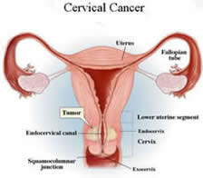Cervical Cancer Care Disparities